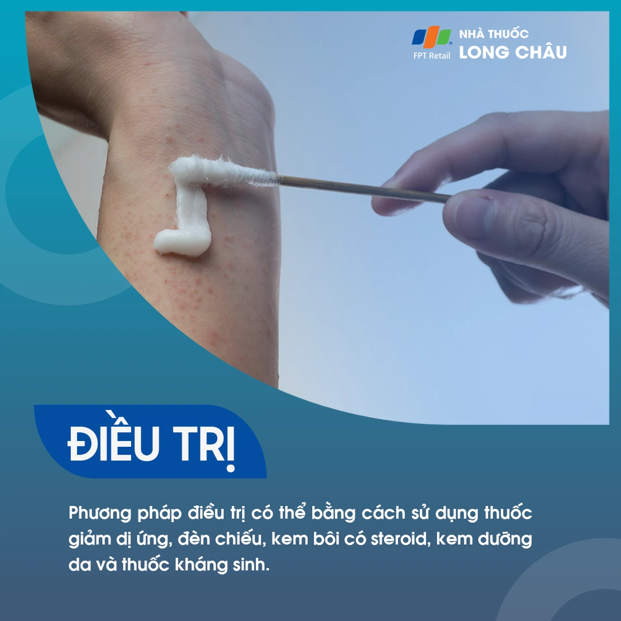 Viêm da: Các biện pháp điều trị tại nhà như sử dụng lô hội, tắm nước mát