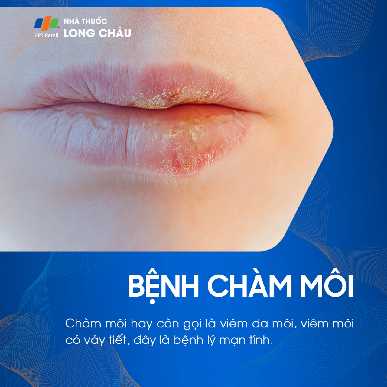 Chàm môi là gì? Nguyên nhân gây bệnh và nguyên tắc phòng ngừa