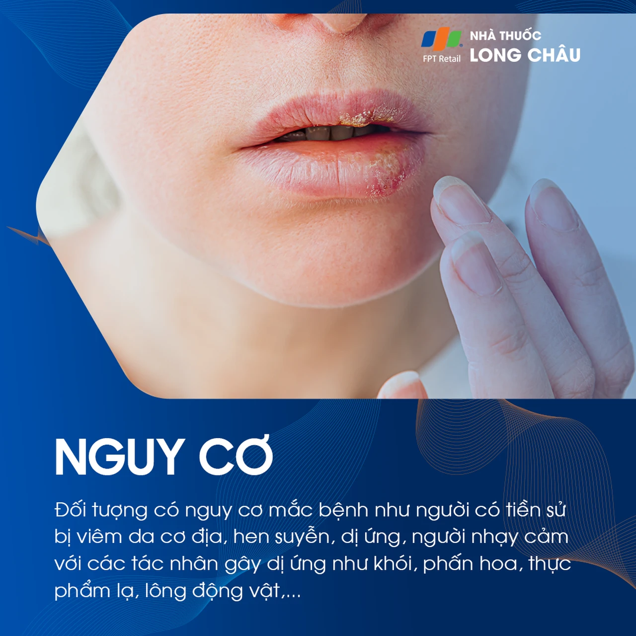 Đối tượng nguy cơ mắc chàm môi là người có da nhạy cảm và dễ bị dị ứng