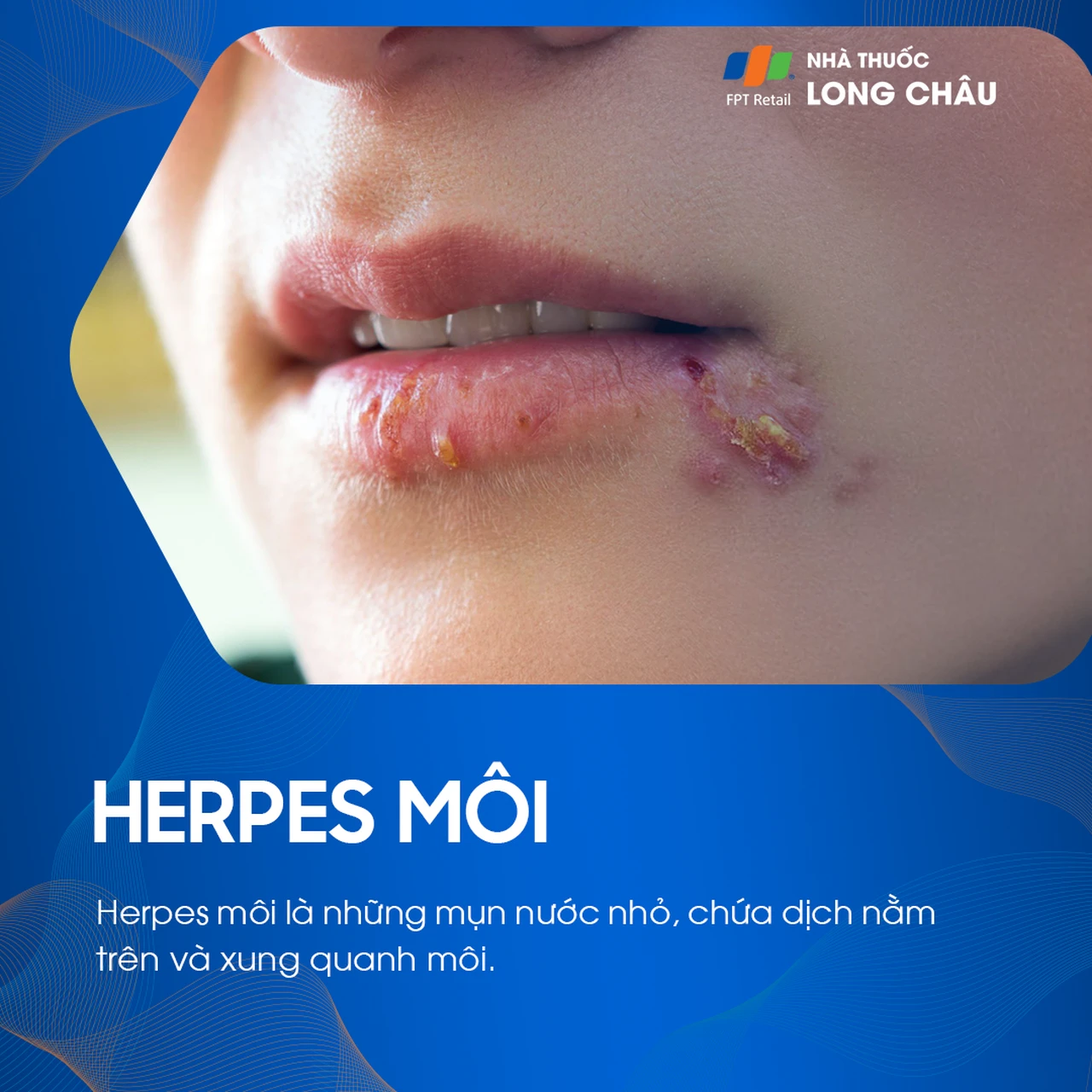 Herpes môi là bệnh gì? Nguyên nhân gây bệnh, cách điều trị và phòng ngừa
