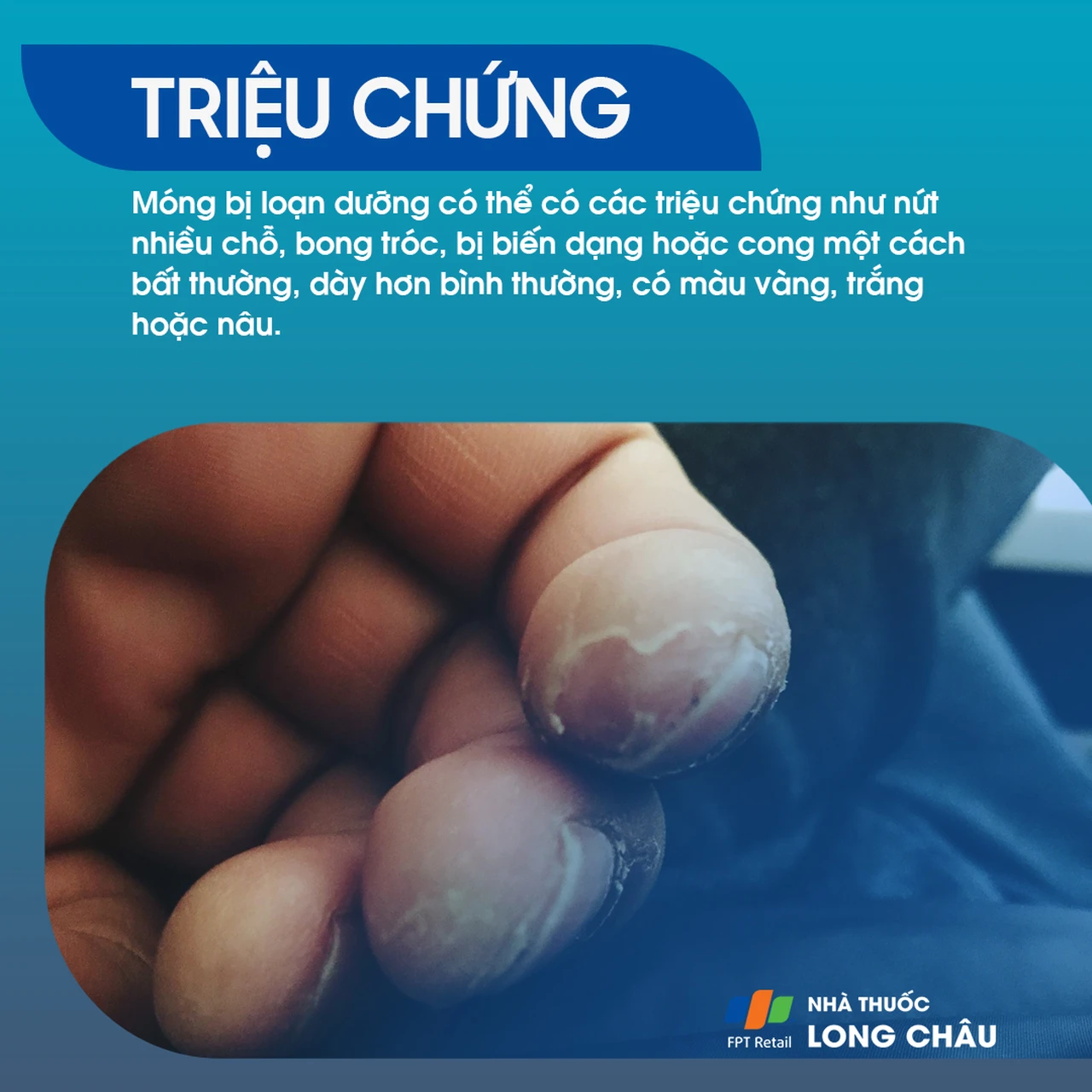 Loạn dưỡng móng 2