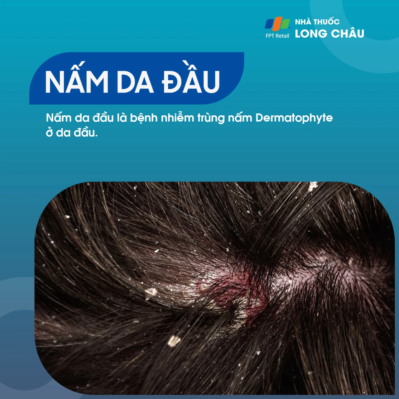Nấm Da Đầu 1