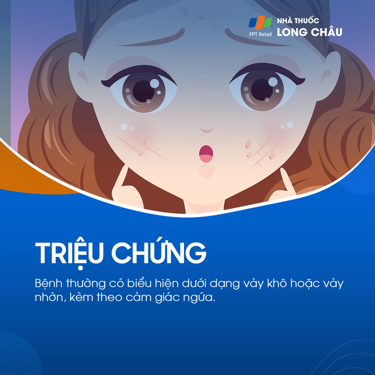 Triệu chứng viêm da tiết bã với da đỏ, nhờn và có vảy