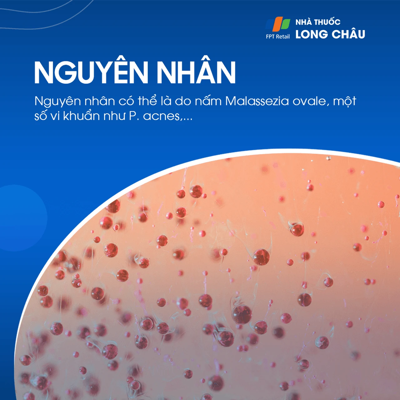 Nguyên nhân viêm da tiết bã do tăng tiết bã nhờn và vi khuẩn Malassezia