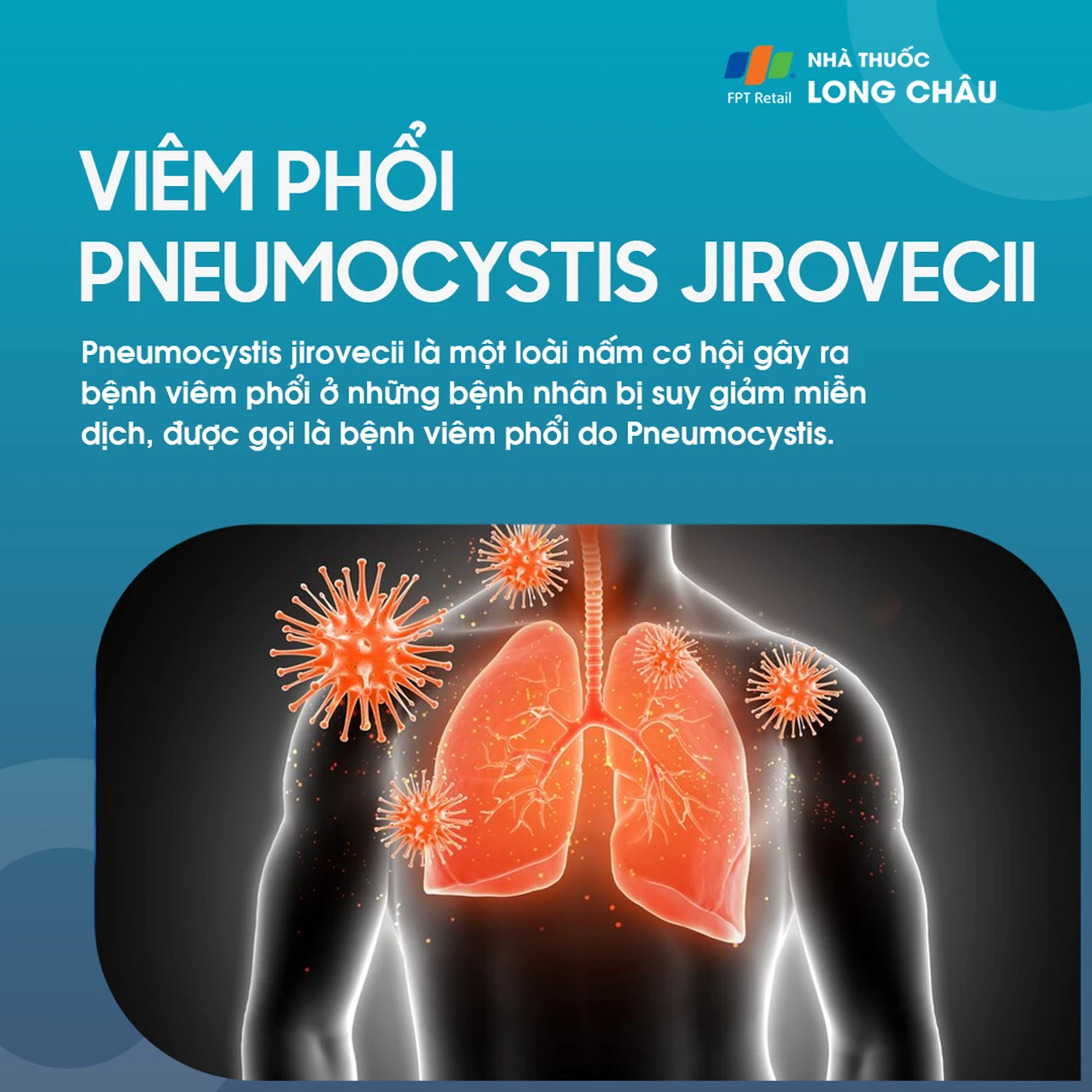 Viêm phổi Pneumocystis jirovecii 1