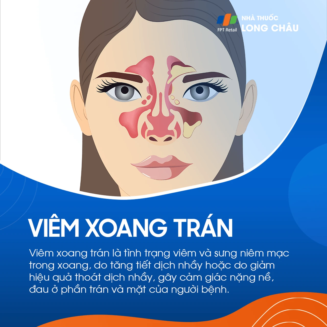 Viêm xoang trán 1