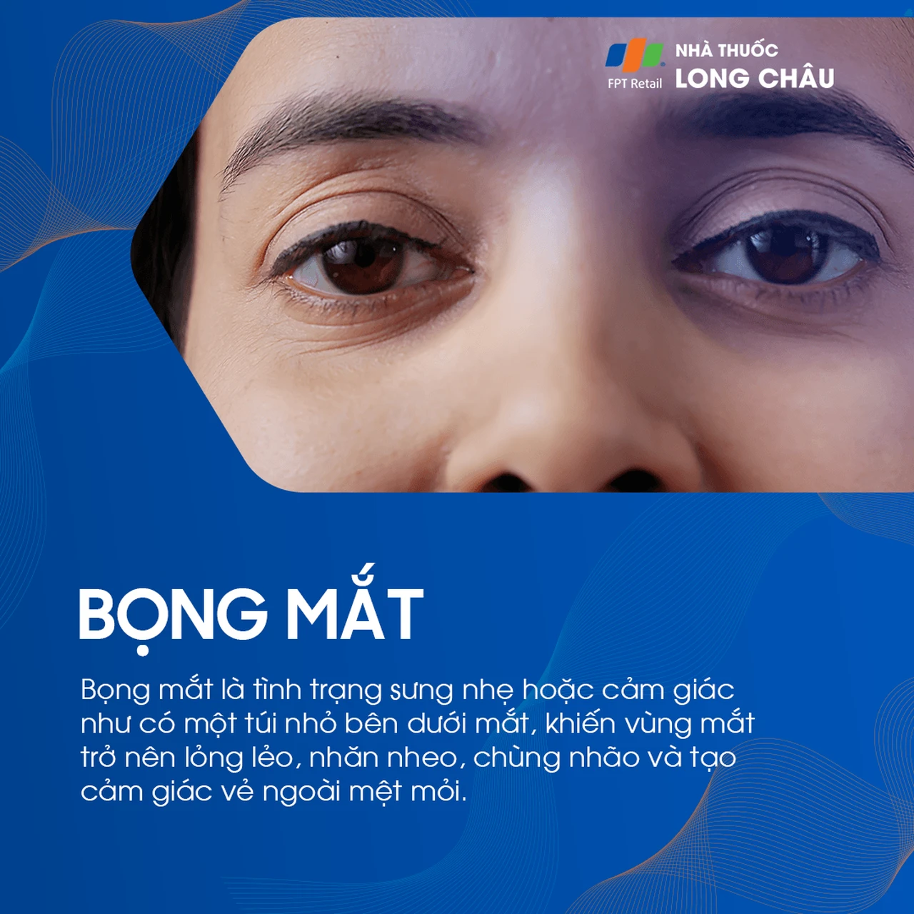 Bọng mắt là tình trạng sưng nhẹ dưới mắt, khiến mắt trông mệt mỏi, nhăn nheo và chùng nhão