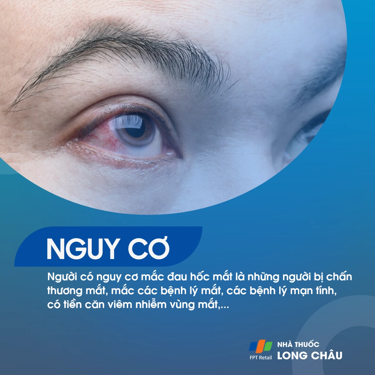Người có nguy cơ đau hốc mắt thường có tiền sử chấn thương mắt, viêm nhiễm vùng mắt, bệnh lý mạn tính hoặc bệnh về mắt