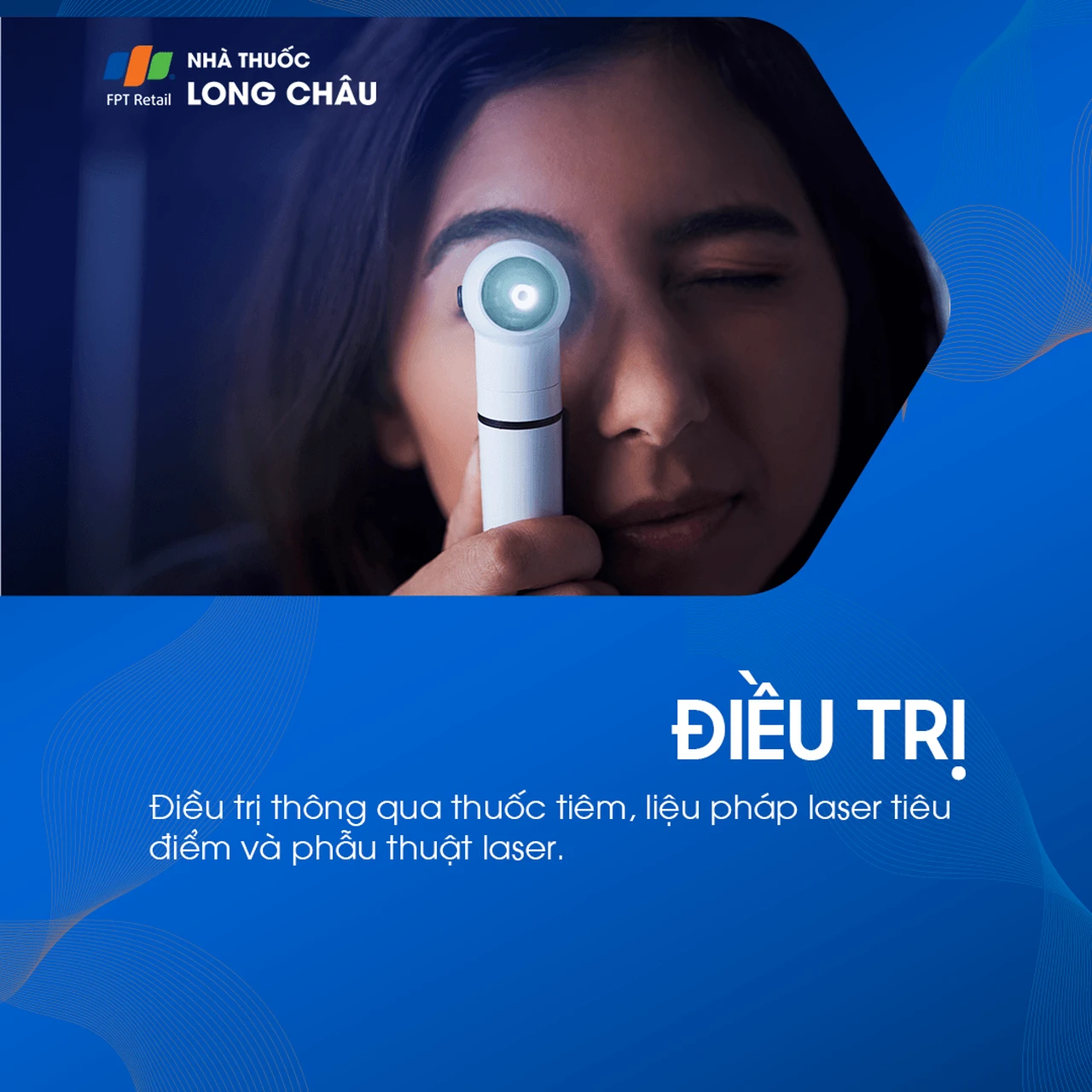 Tắc tĩnh mạch võng mạc 6