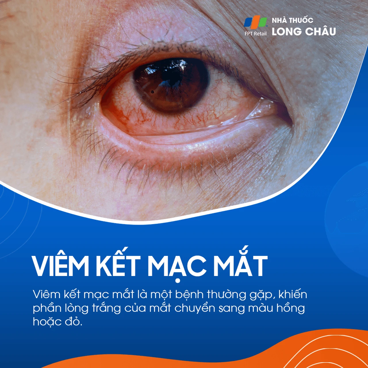 Viêm kết mạc mắt 1