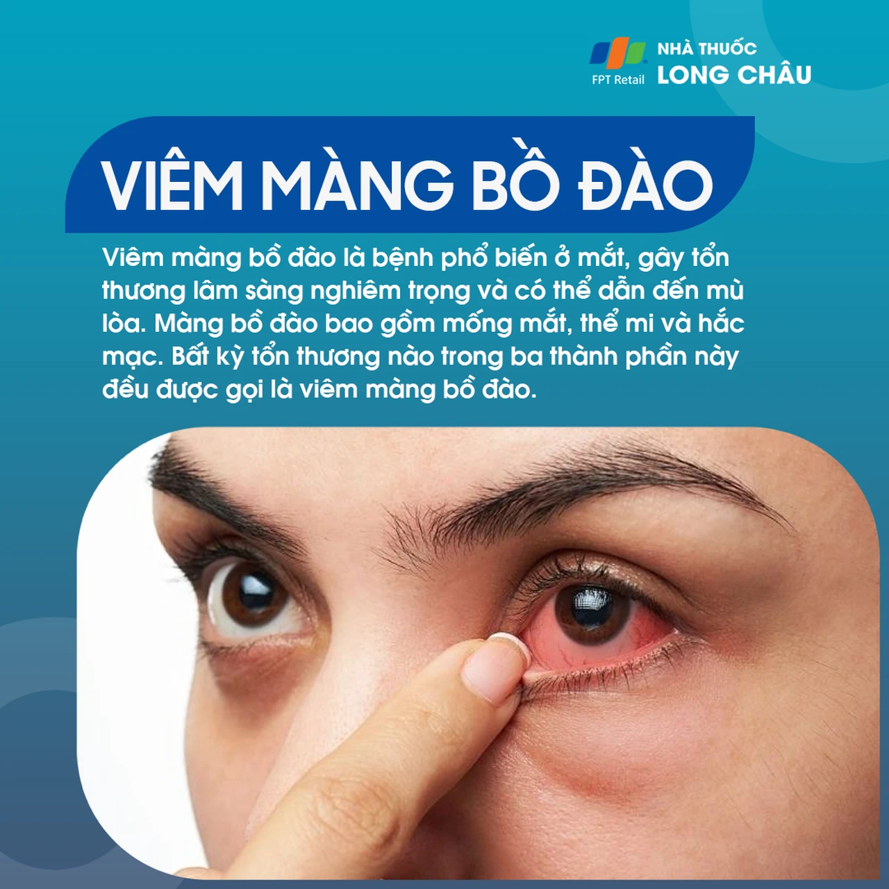 Viêm màng bồ đào 1