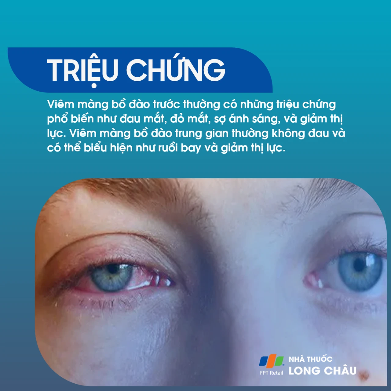 Viêm màng bồ đào 3