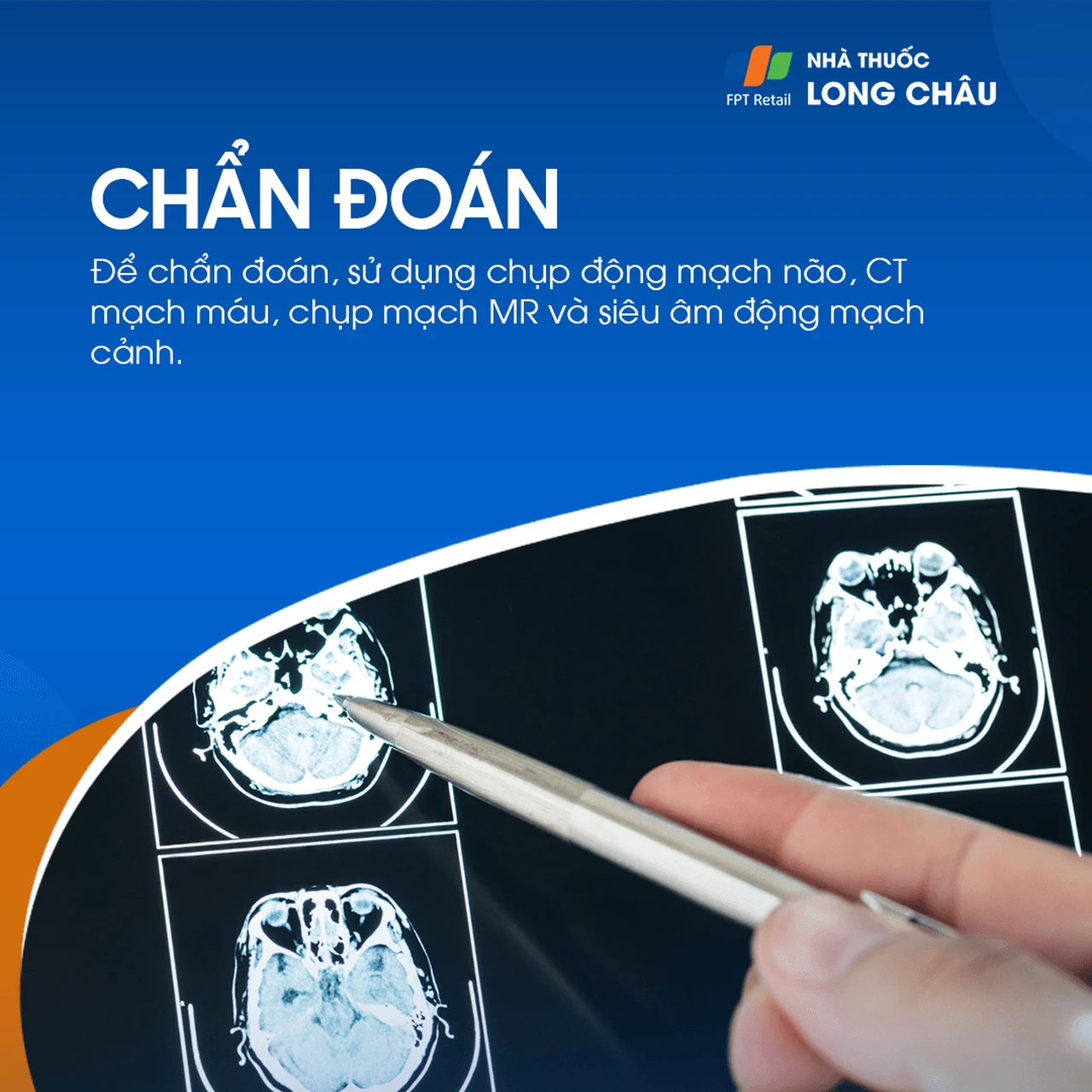 Hẹp động mạch cảnh 5