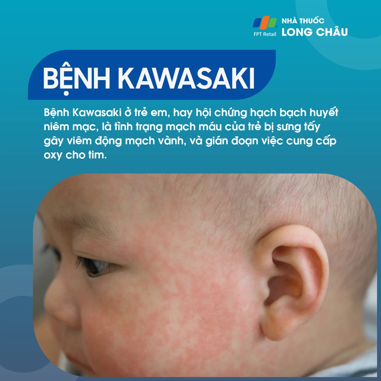 Bệnh Kawasaki – Bệnh viêm mạch máu ở trẻ em, gây sưng viêm động mạch vành và cản trở cung cấp oxy cho tim