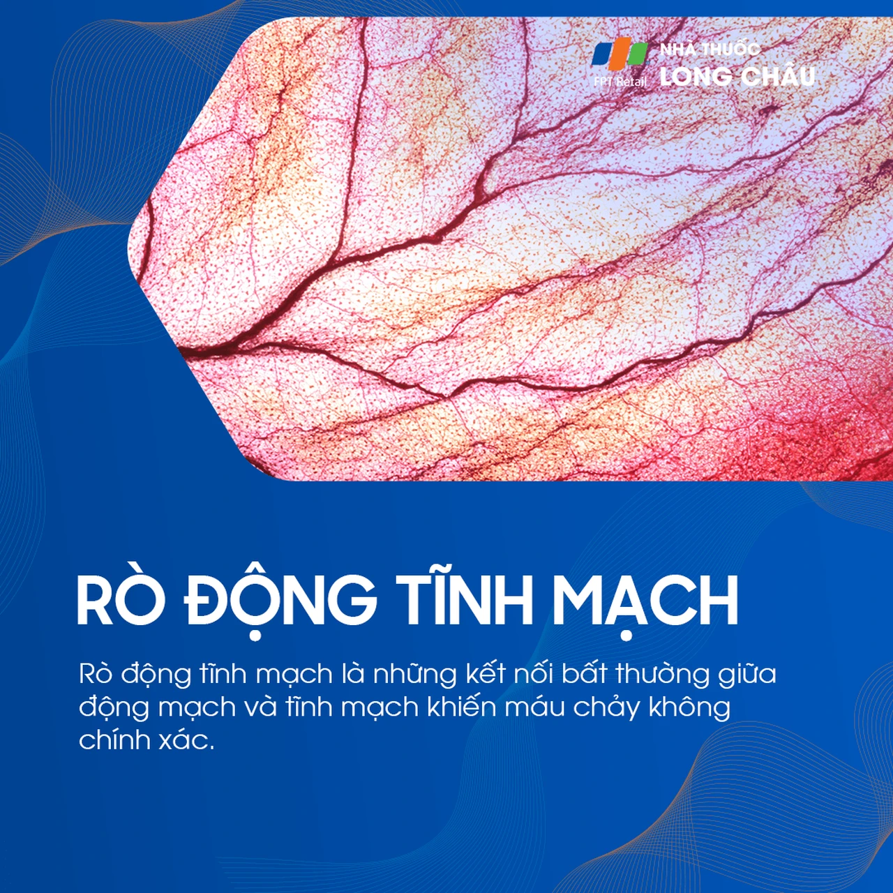rò động tĩnh mạch 1