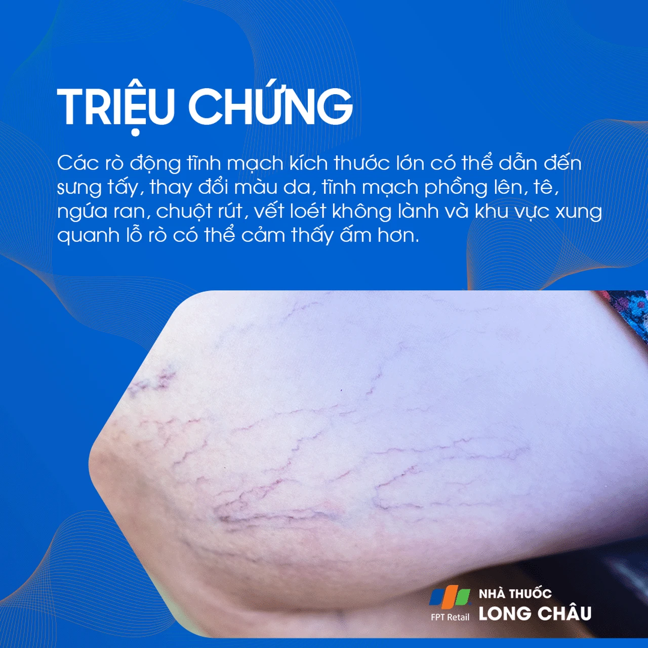 Rò động tĩnh mạch 2