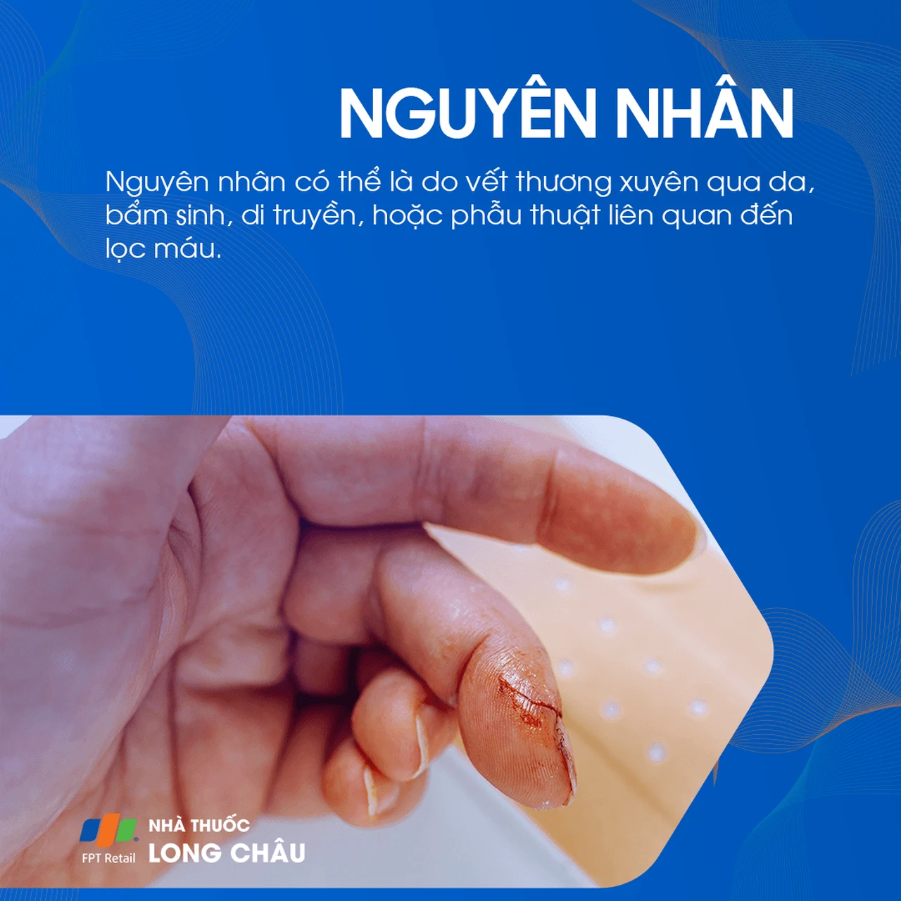 Rò động tĩnh mạch 3