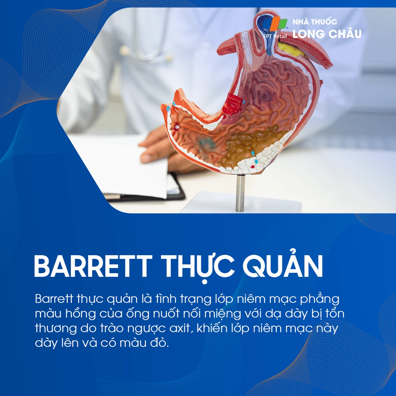Barrett thực quản 1