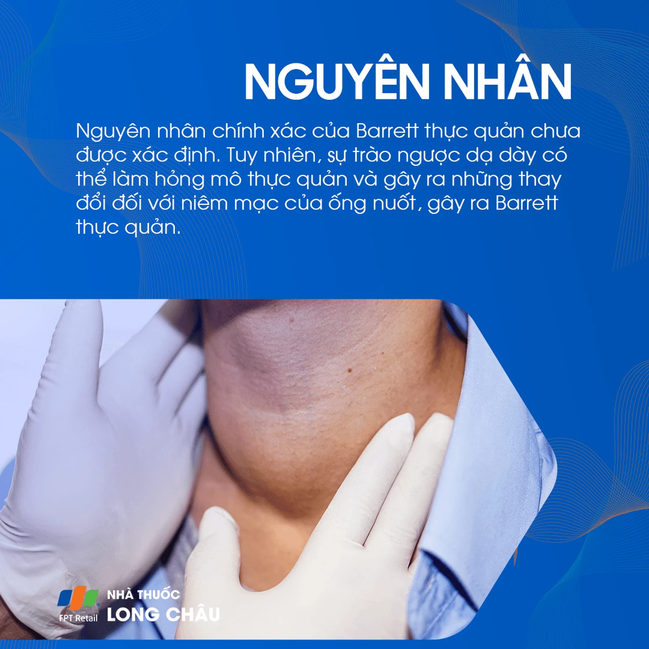 Barrett thực quản 3