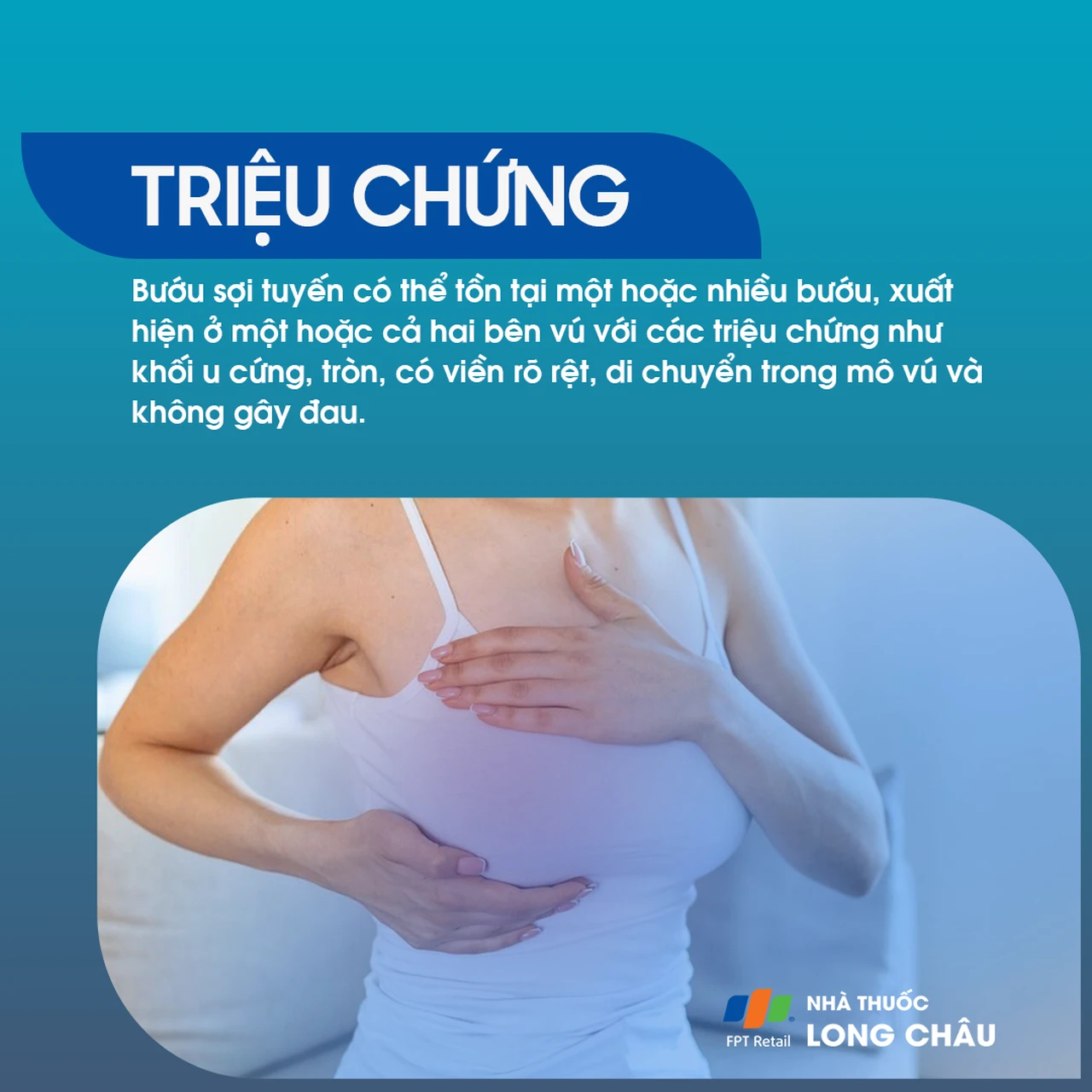 Bướu sợi tuyến 2