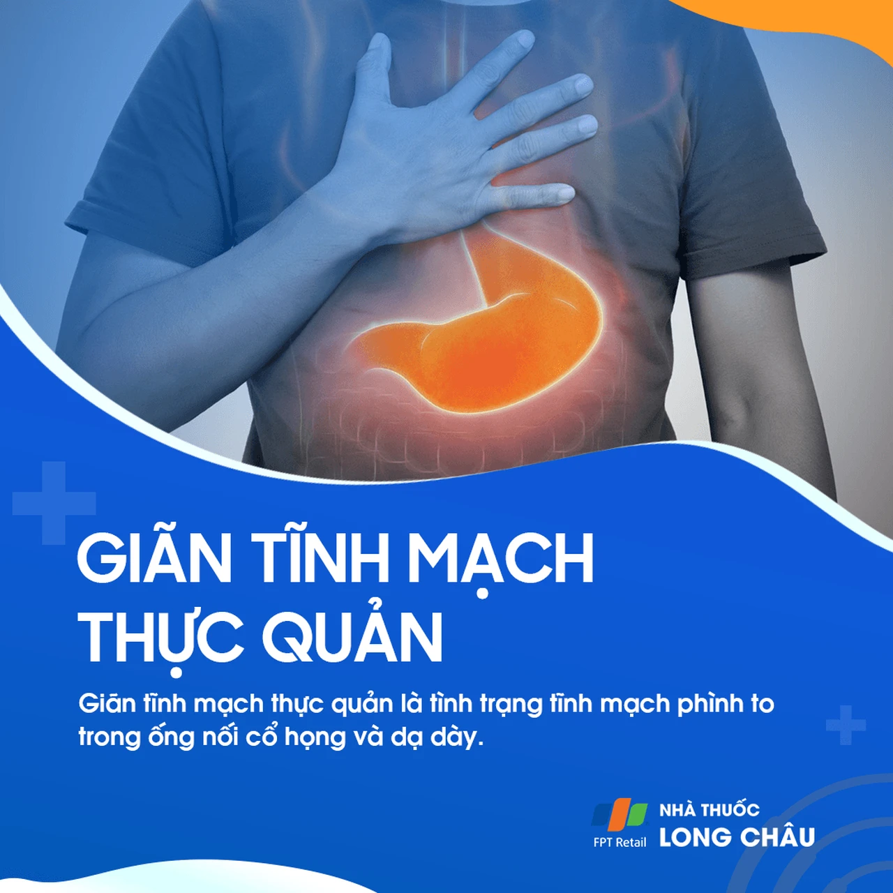 Giãn tĩnh mạch thực quản 1