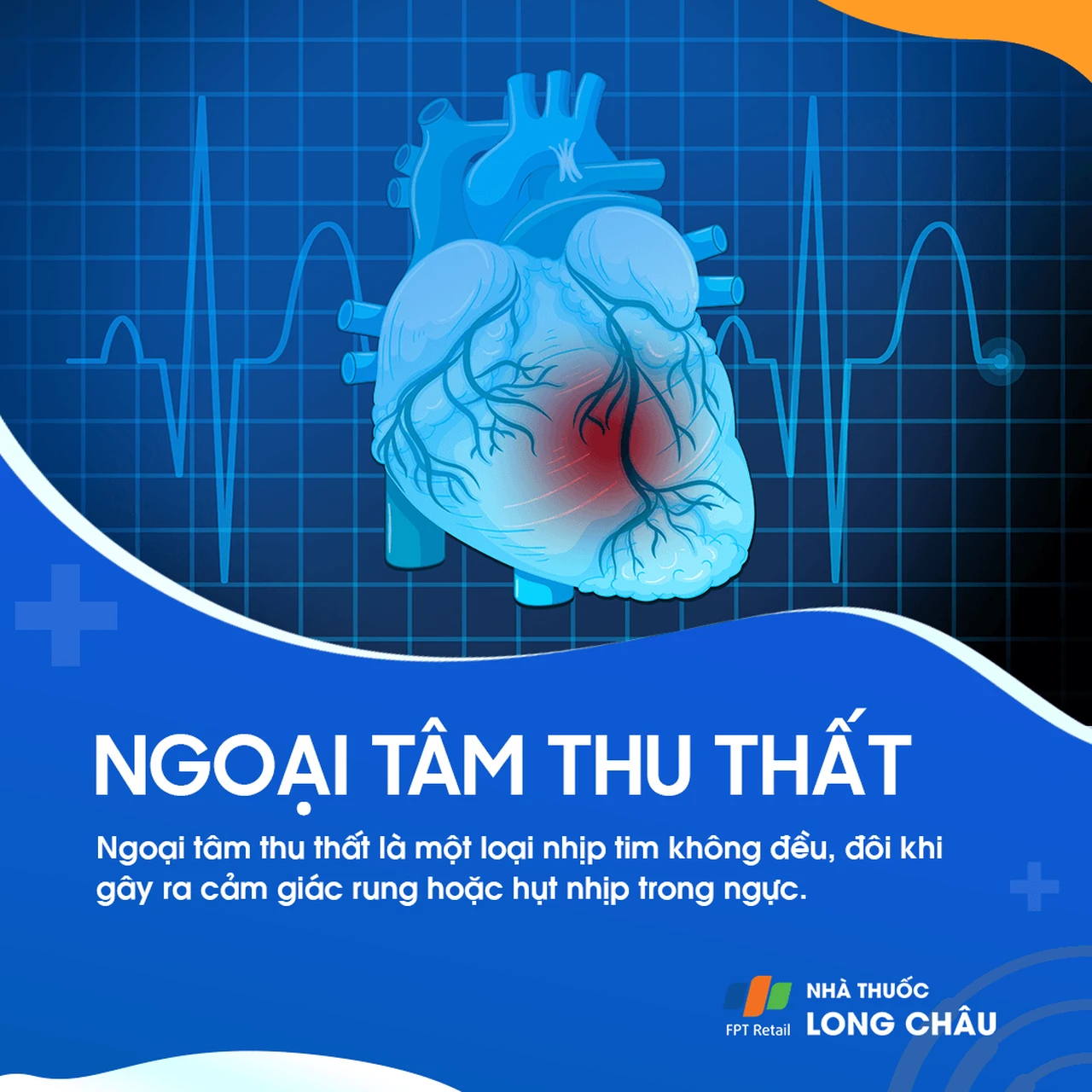 ngoại tâm thu thất, một loại rối loạn nhịp tim xuất phát từ thất