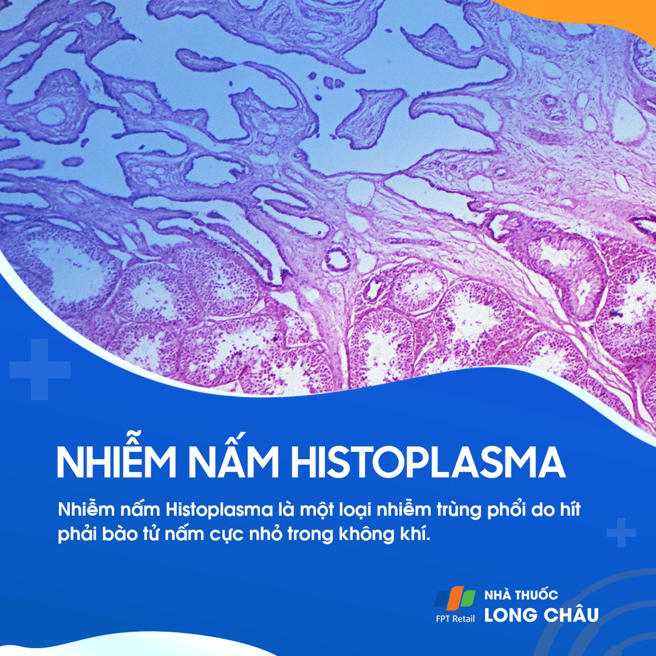 Nhiễm nấm Histoplasma 1