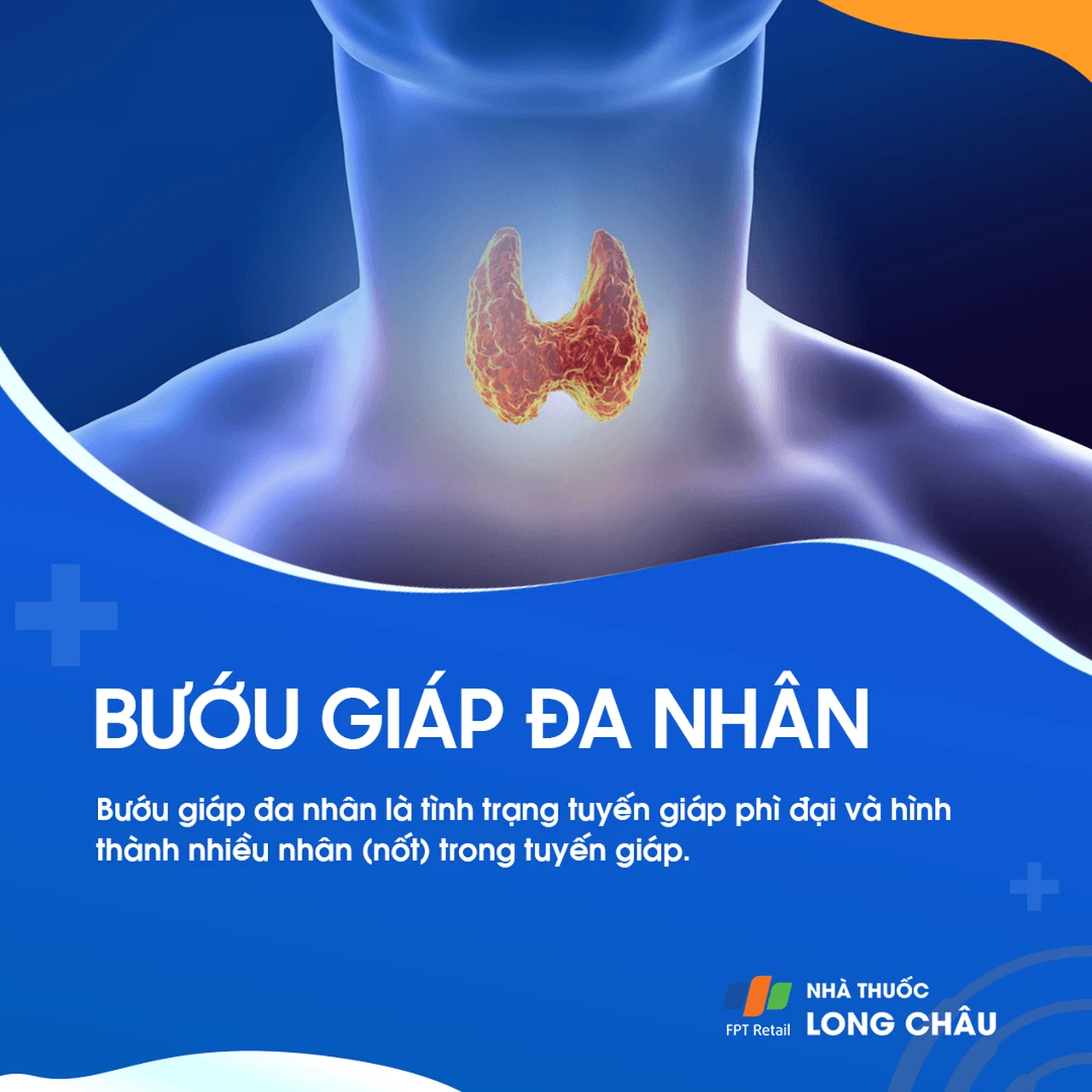 Bướu giáp đa nhân 1