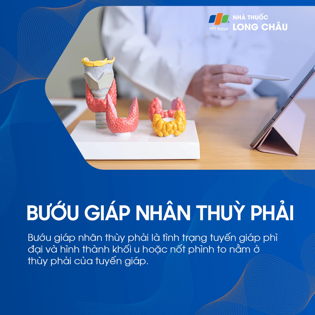 Bướu giáp nhân thùy phải 1
