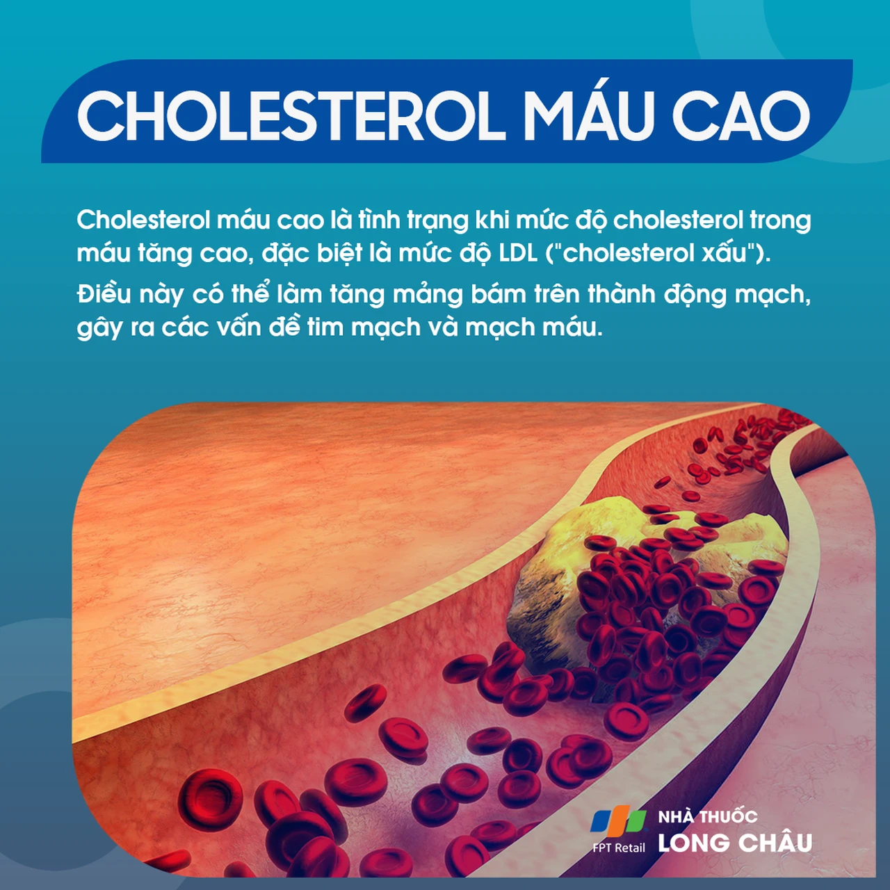 Là tình trạng mức cholesterol, đặc biệt LDL (“cholesterol xấu”) trong máu tăng cao, gây bám mảng vào thành mạch và ảnh hưởng tim mạch