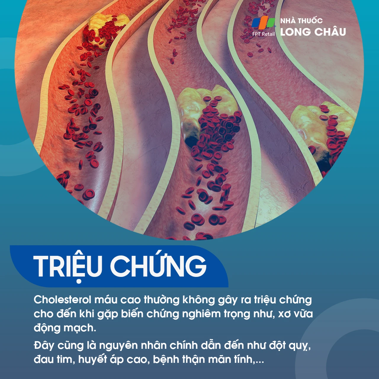 Cholesterol cao thường không có triệu chứng cho đến khi xảy ra biến chứng như xơ vữa mạch, đột quỵ, đau tim, huyết áp cao