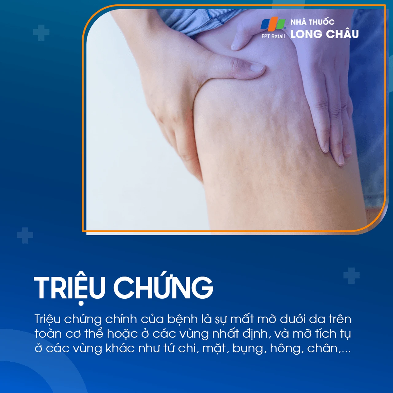 Loạn dưỡng mỡ 2