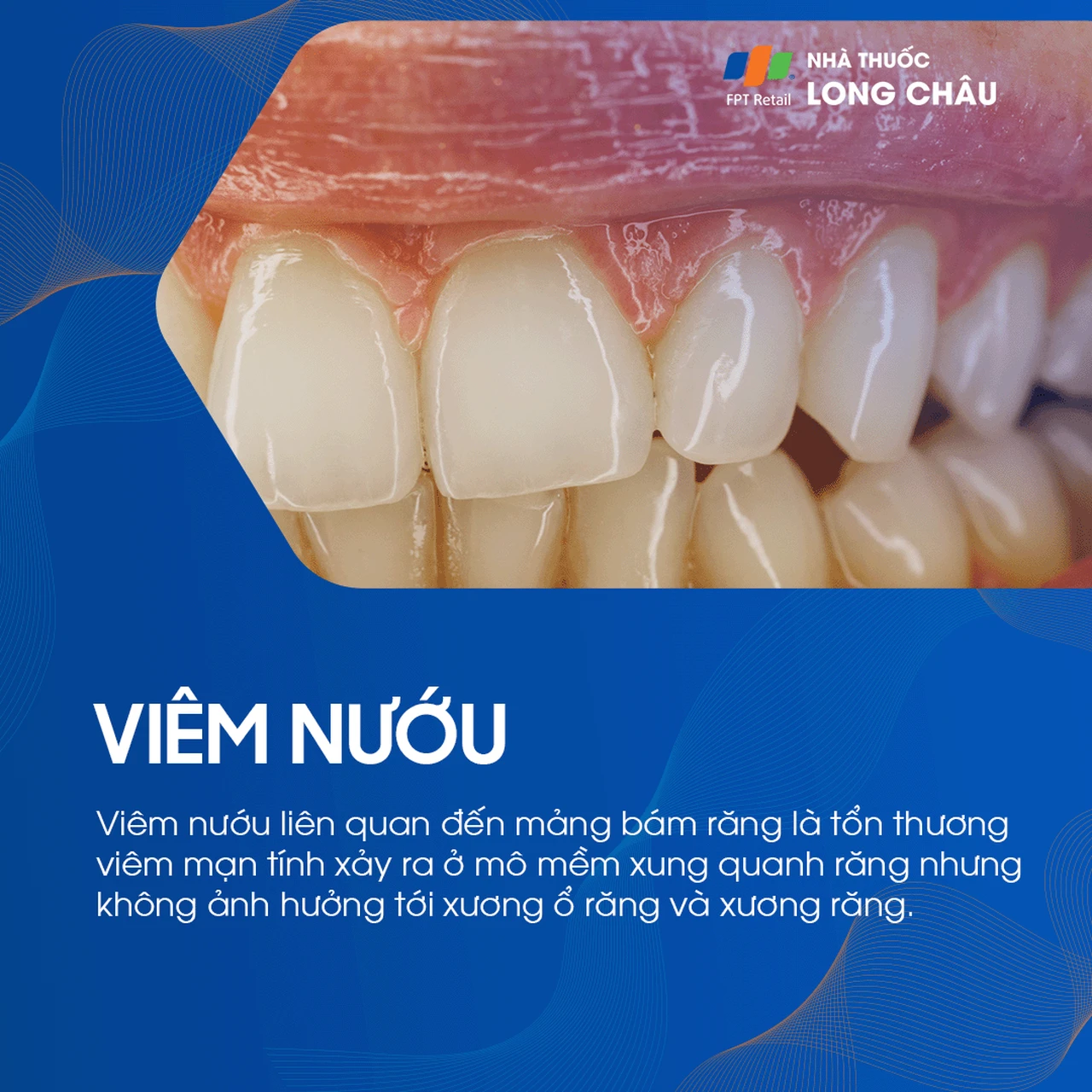 Bệnh nướu và nha chu 2