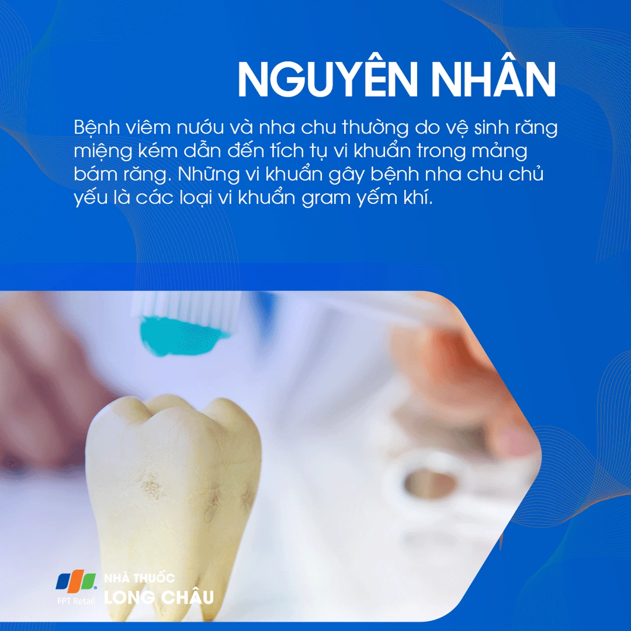 Bệnh nướu và nha chu 5