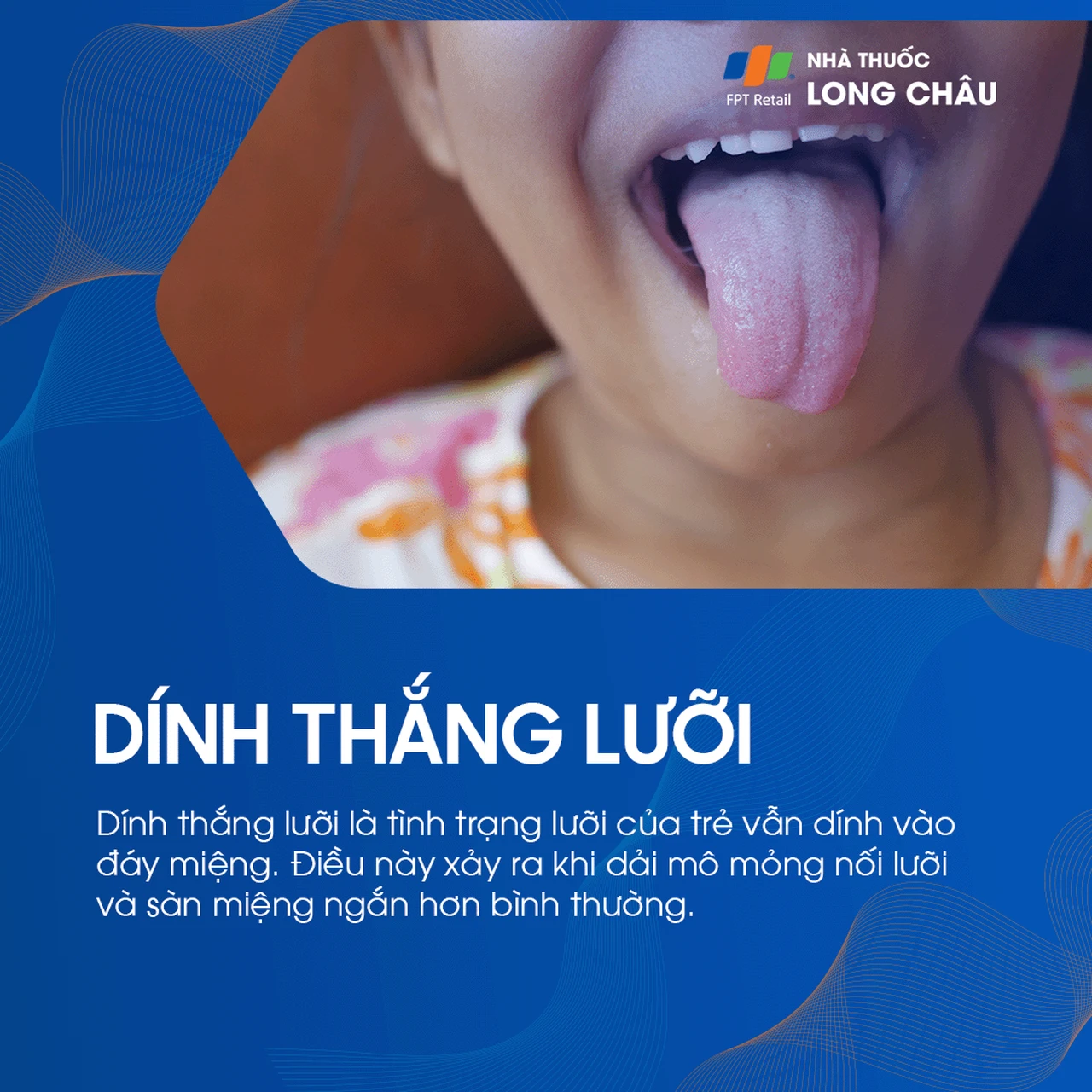 Dính thắng lưỡi 1