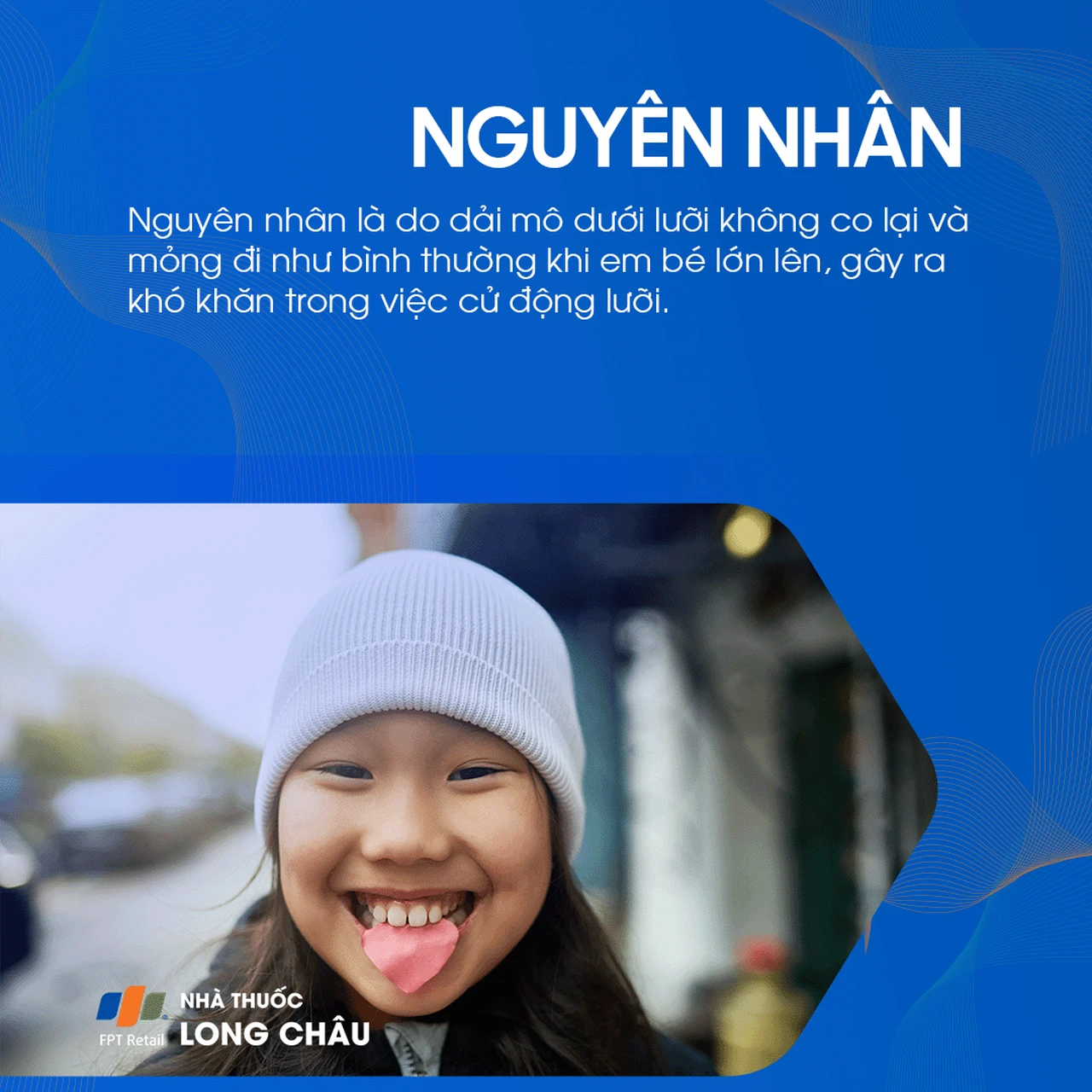 Dính thắng lưỡi 3