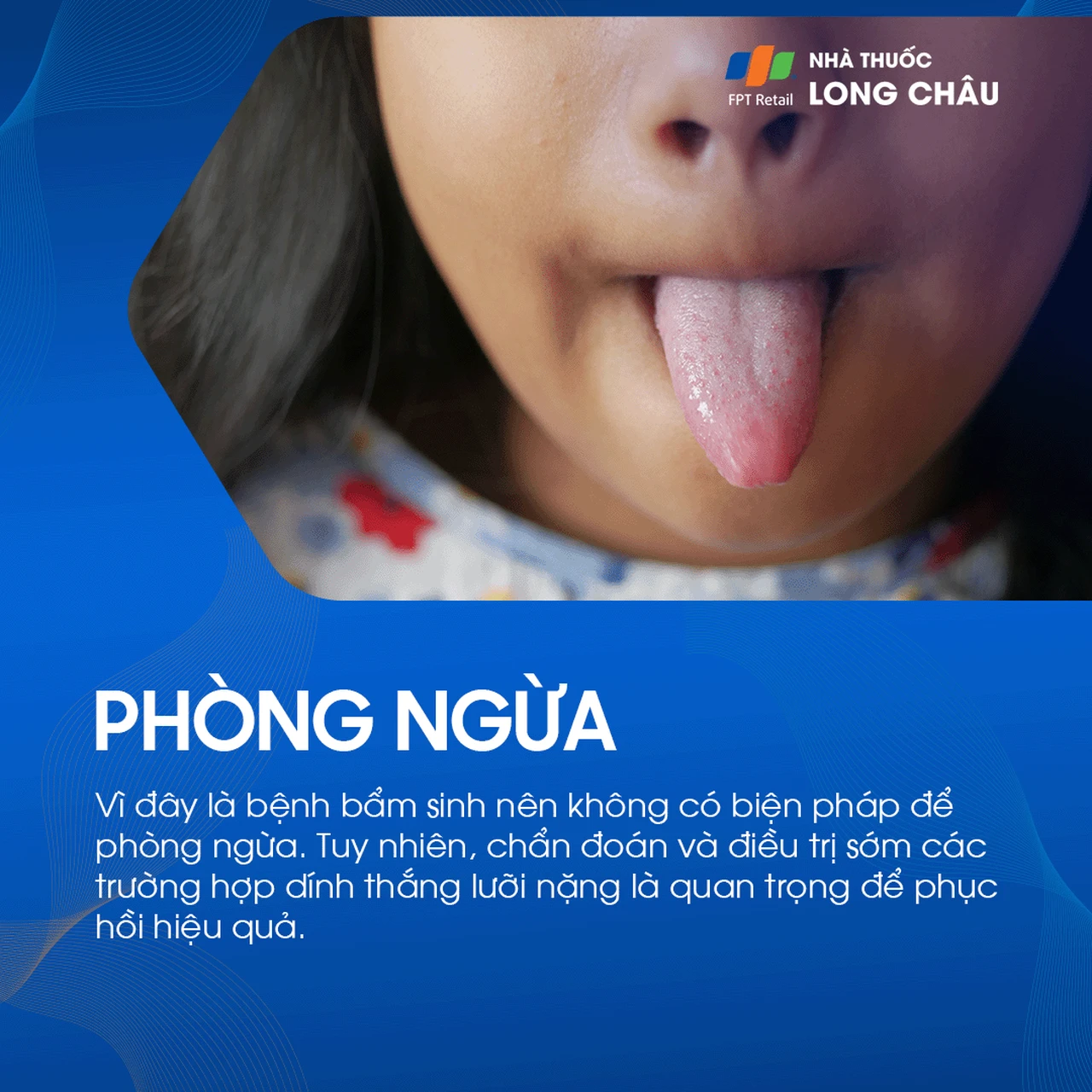 Dính thắng lưỡi 7