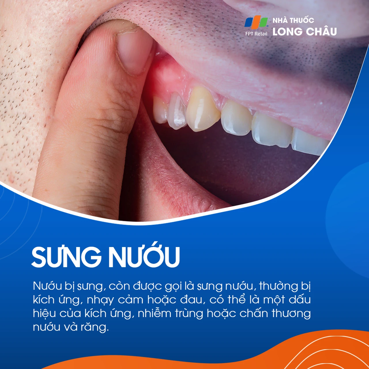 Sưng nướu 1