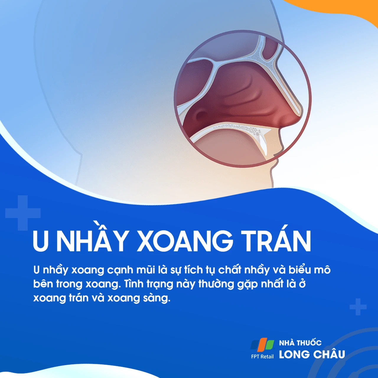 U nhầy xoang trán 1