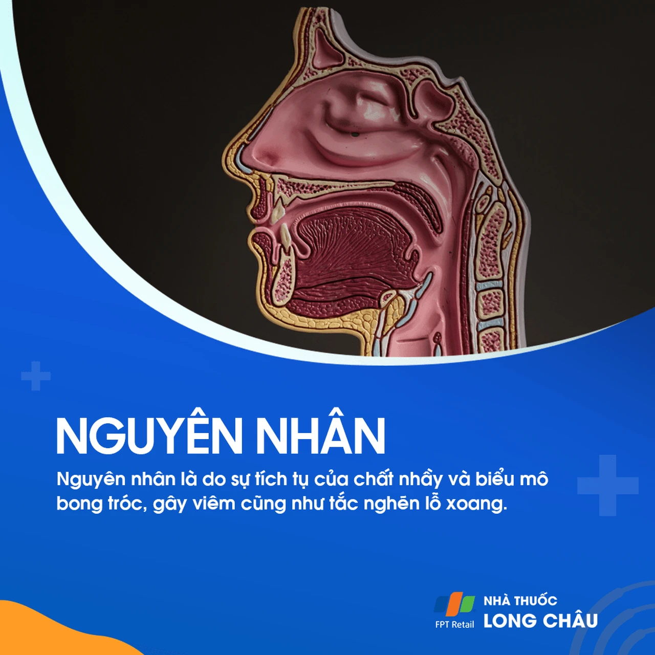 U nhầy xoang trán 3