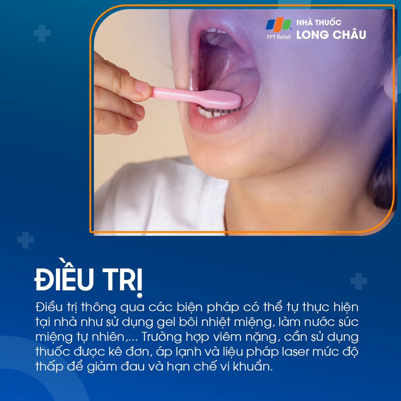 Điều trị viêm loét miệng