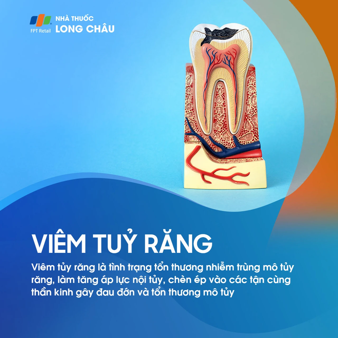Viêm tủy răng 1