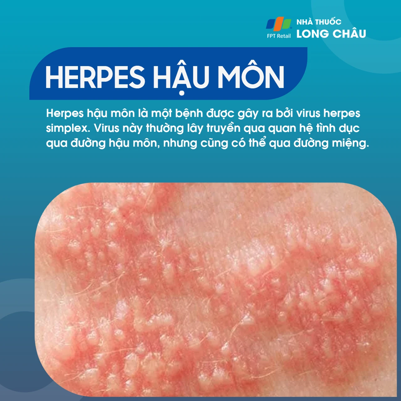 Herpes hậu môn 1