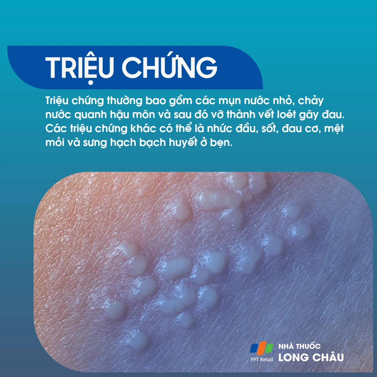Herpes hậu môn 2