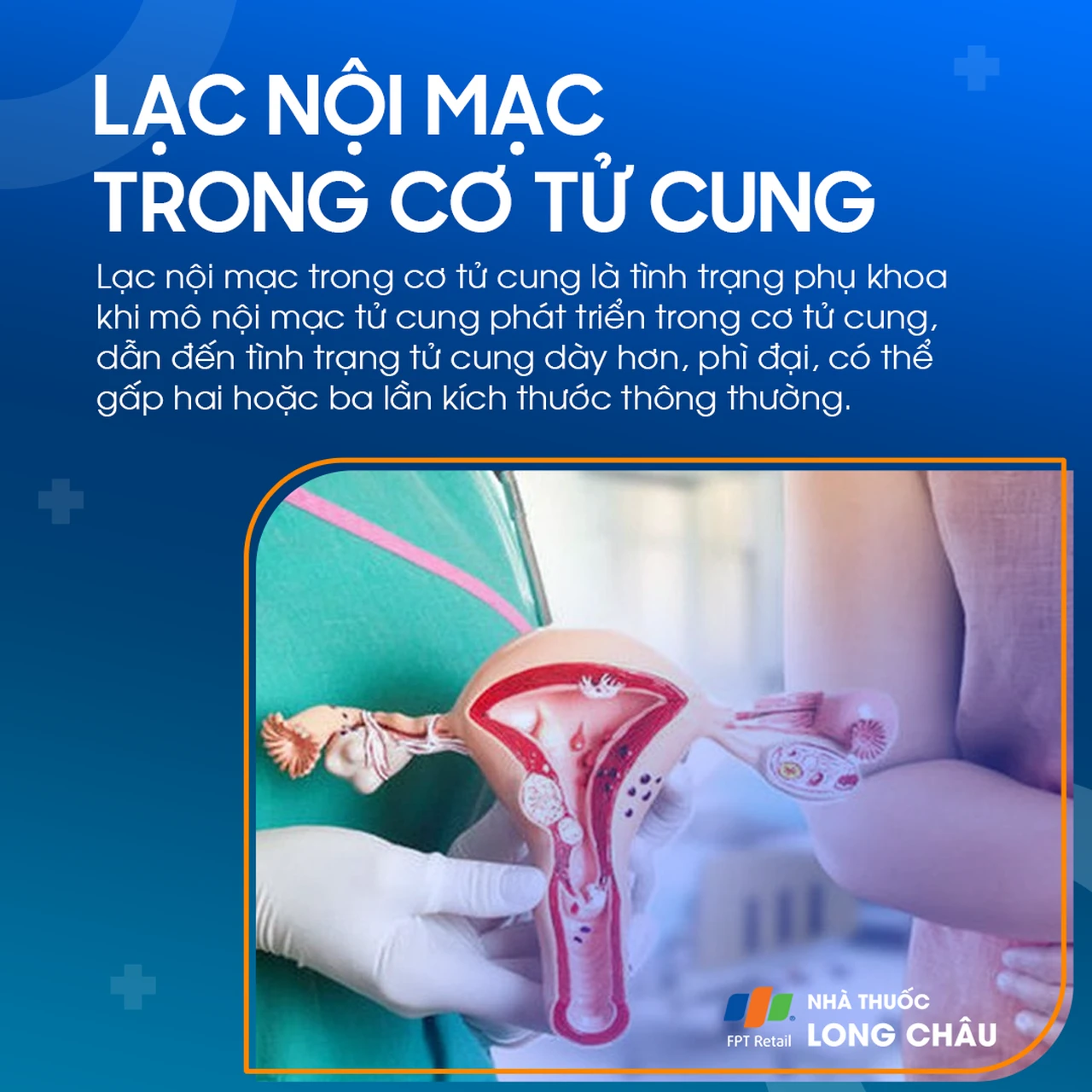 Lạc nội mạc trong cơ tử cung 1