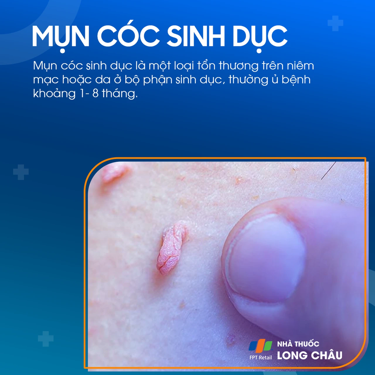 Mụn cơm (mụn cóc) sinh dục là một loại tổn thương trên niêm mạc hoặc da ở bộ phận sinh dục