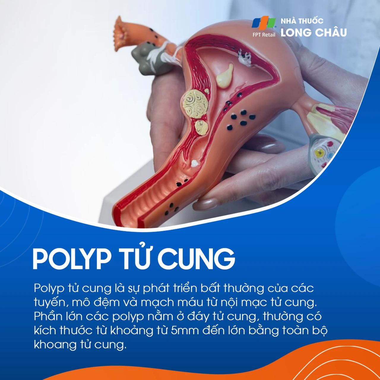 Polyp tử cung 1