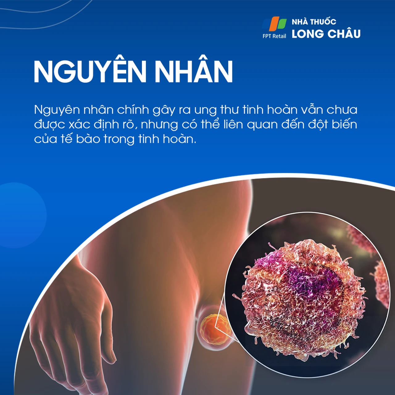 Ung thư tinh hoàn 3