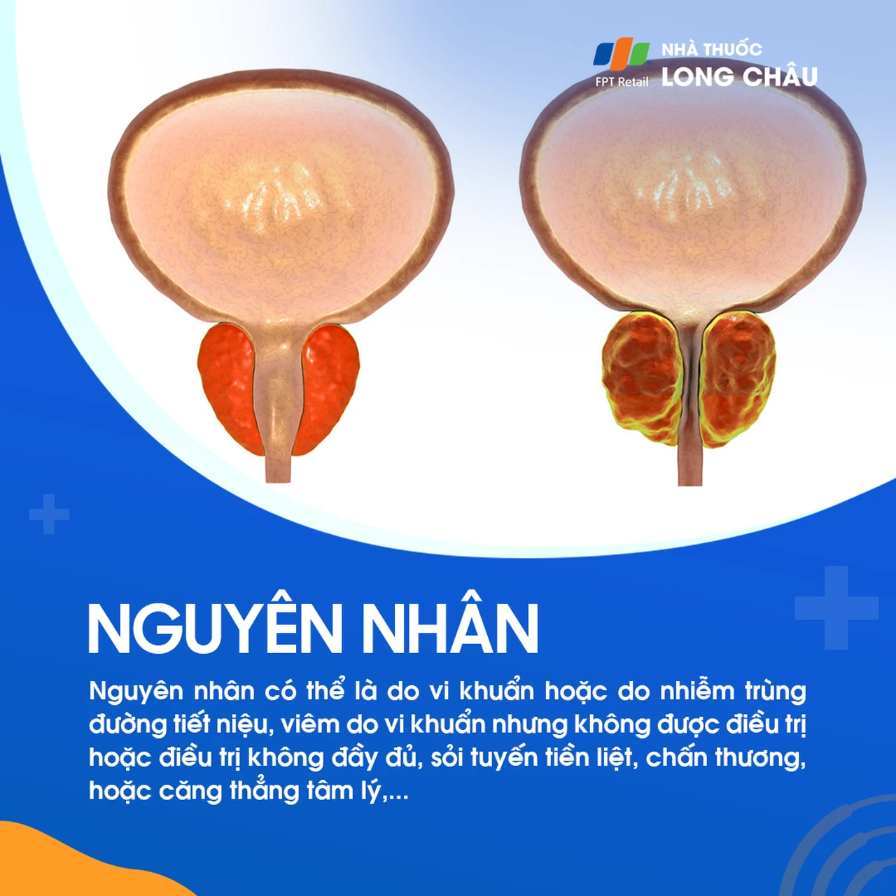 Viêm tuyến tiền liệt mạn tính 3