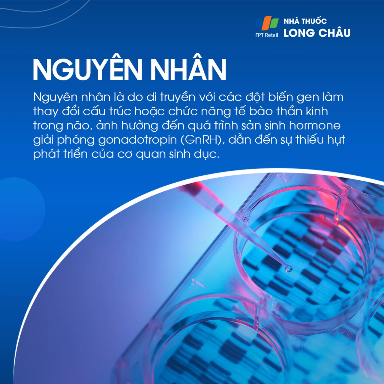 Hội chứng Kallmann 4